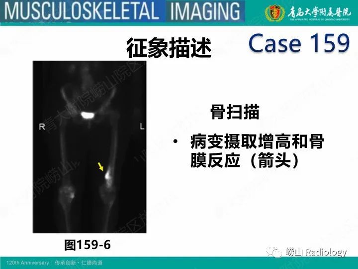 影像PPT - 【PPT】软骨肉瘤-39