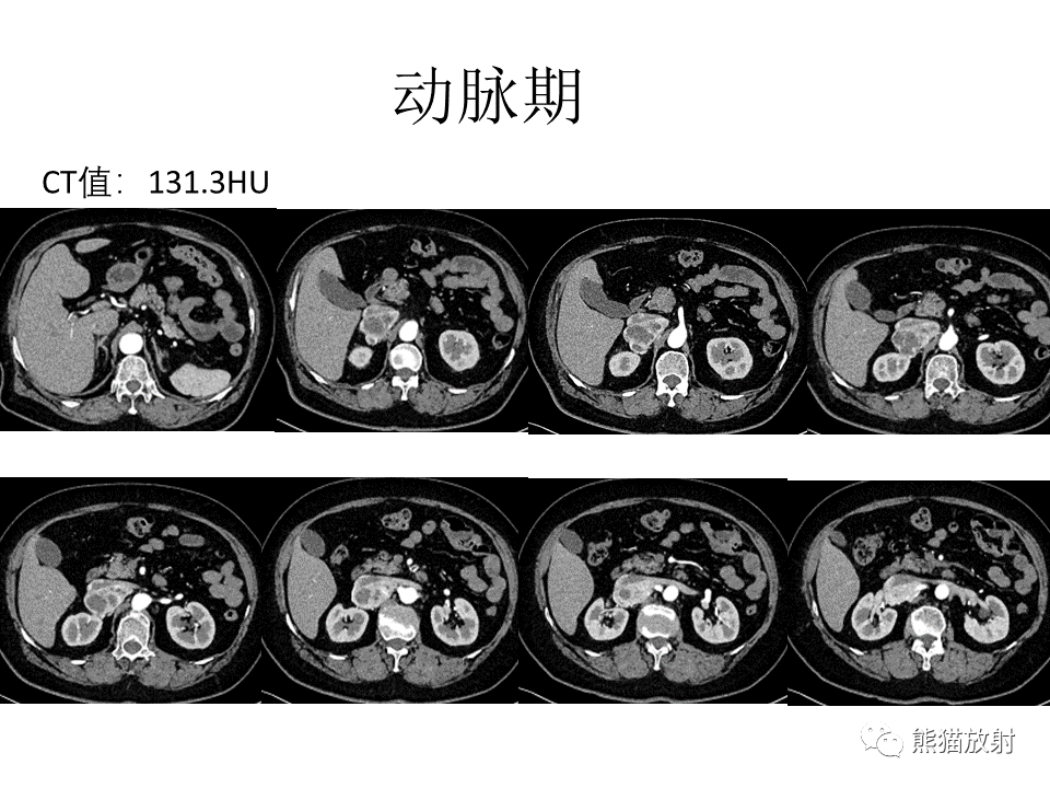 影像PPT - 【病例】腹膜后副神经节瘤 VS 平滑肌肉瘤-4