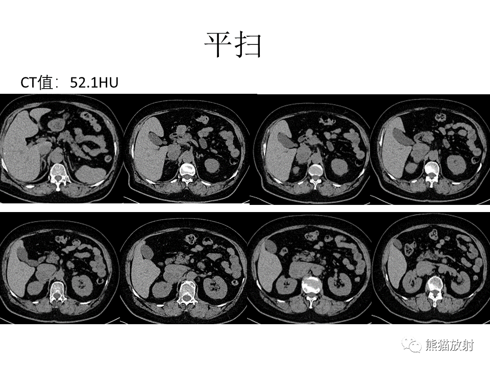 影像PPT - 【病例】腹膜后副神经节瘤 VS 平滑肌肉瘤-3