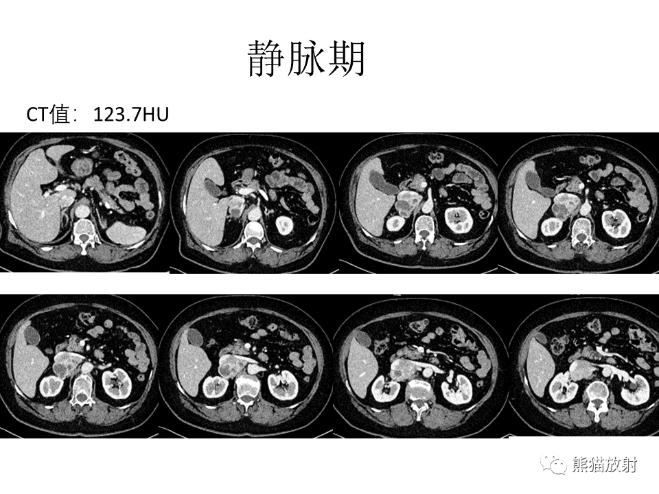 影像PPT - 【病例】腹膜后副神经节瘤 VS 平滑肌肉瘤-5