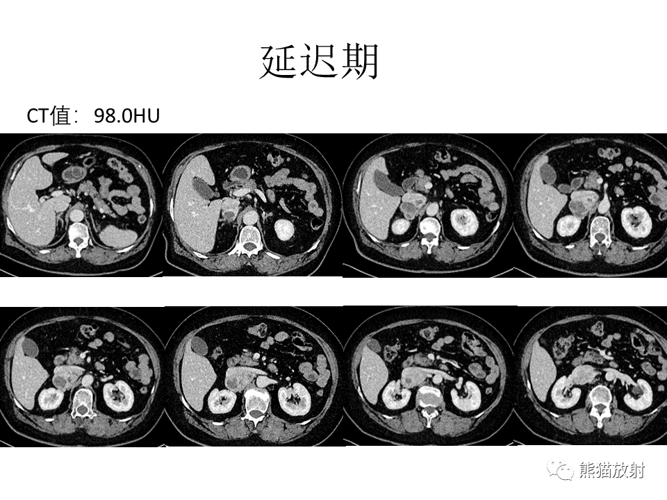 影像PPT - 【病例】腹膜后副神经节瘤 VS 平滑肌肉瘤-6