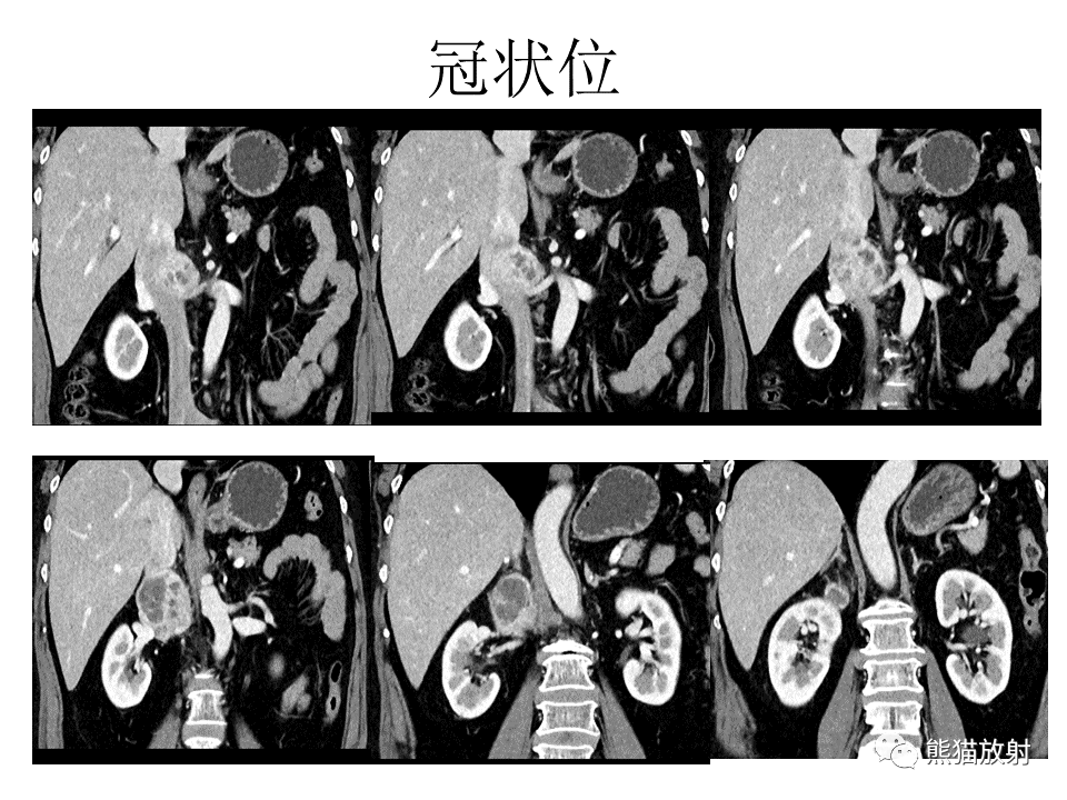 影像PPT - 【病例】腹膜后副神经节瘤 VS 平滑肌肉瘤-7
