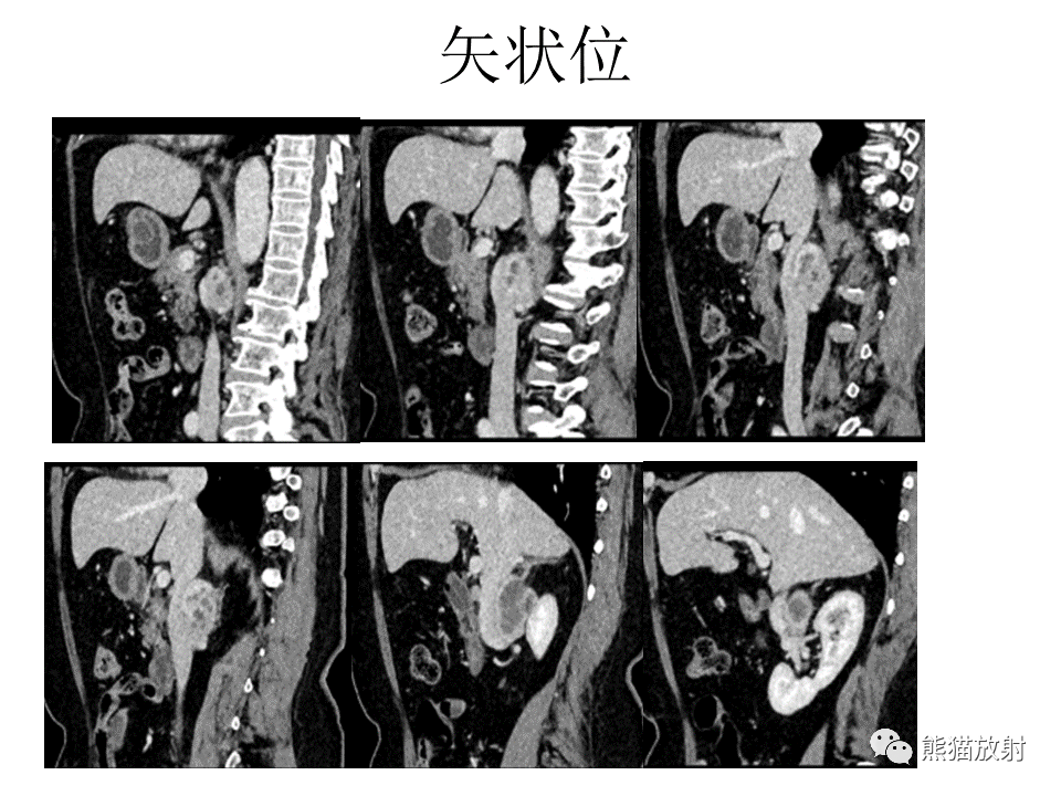 影像PPT - 【病例】腹膜后副神经节瘤 VS 平滑肌肉瘤-8