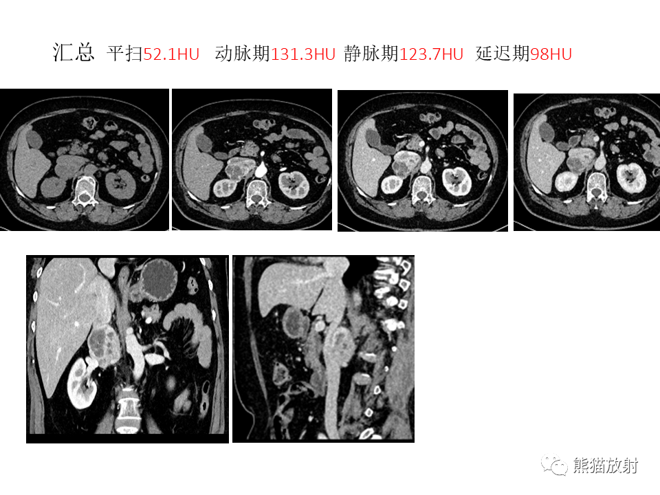 影像PPT - 【病例】腹膜后副神经节瘤 VS 平滑肌肉瘤-9