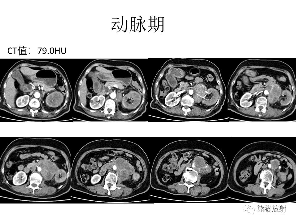 影像PPT - 【病例】腹膜后副神经节瘤 VS 平滑肌肉瘤-13
