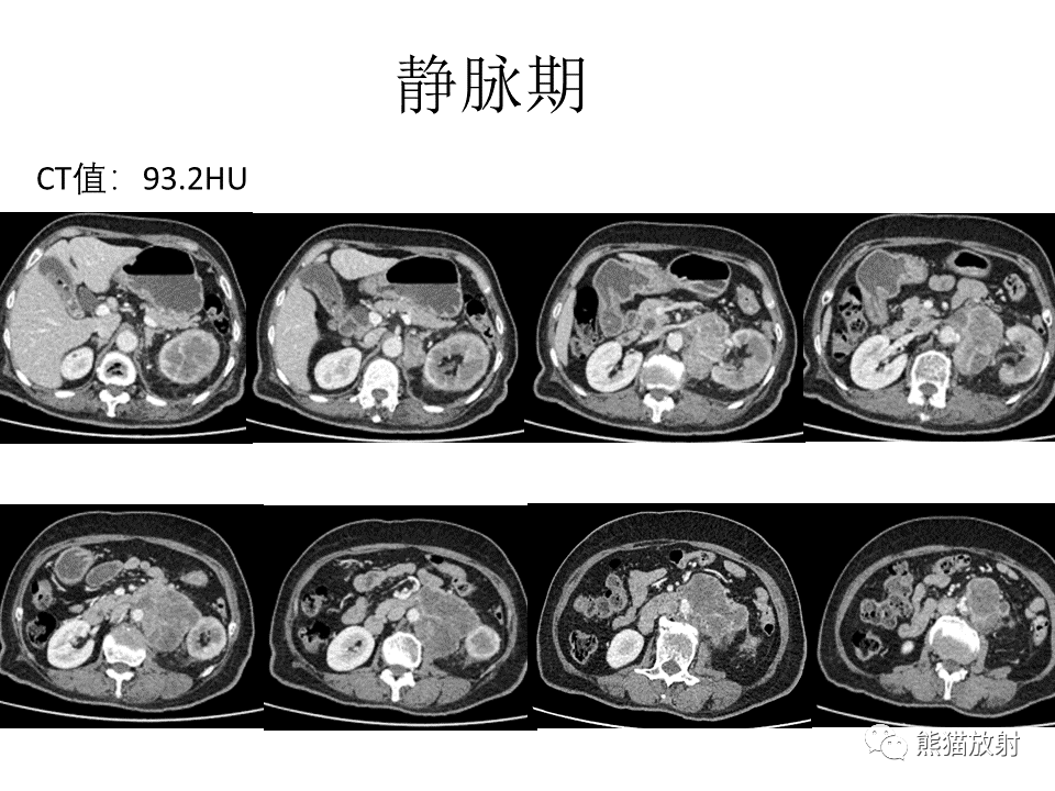 影像PPT - 【病例】腹膜后副神经节瘤 VS 平滑肌肉瘤-14