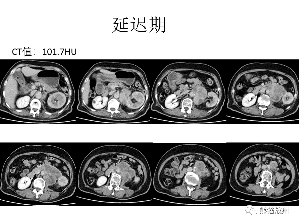 影像PPT - 【病例】腹膜后副神经节瘤 VS 平滑肌肉瘤-15