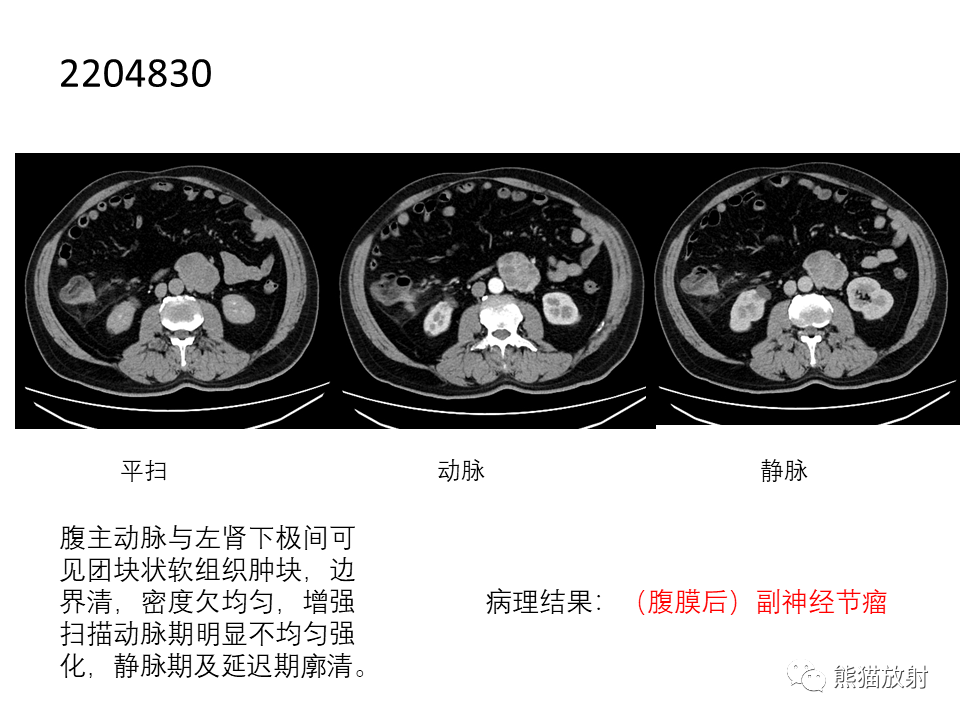 影像PPT - 【病例】腹膜后副神经节瘤 VS 平滑肌肉瘤-28
