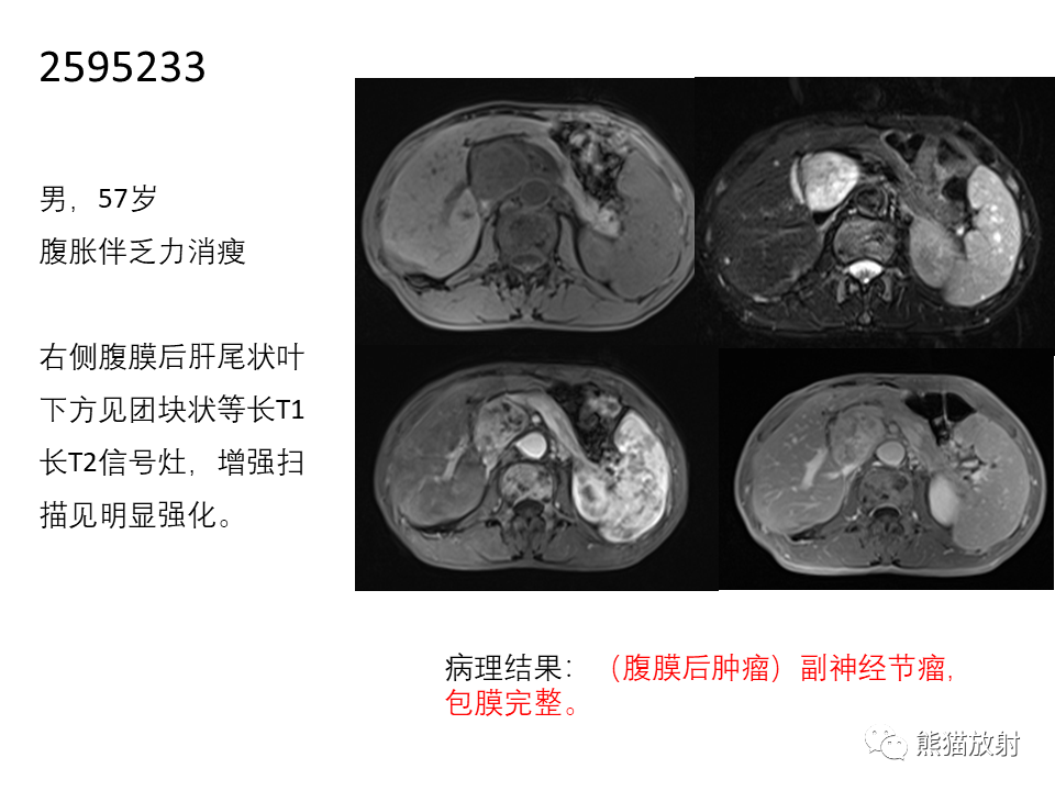 影像PPT - 【病例】腹膜后副神经节瘤 VS 平滑肌肉瘤-29