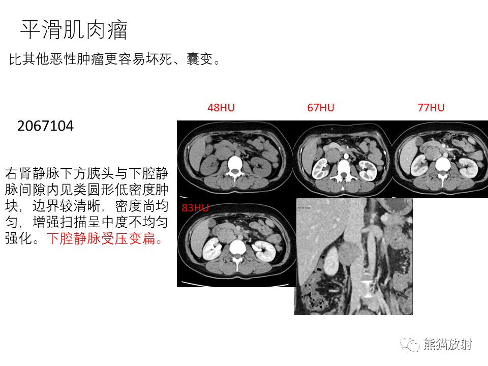 影像PPT - 【病例】腹膜后副神经节瘤 VS 平滑肌肉瘤-32