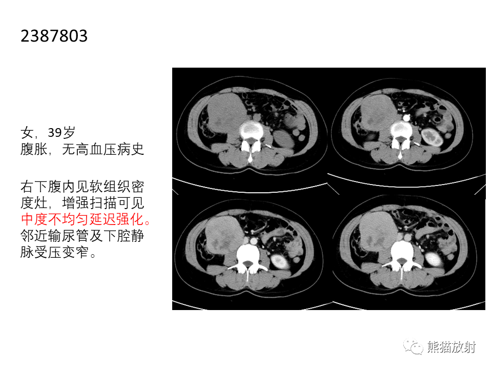 影像PPT - 【病例】腹膜后副神经节瘤 VS 平滑肌肉瘤-33