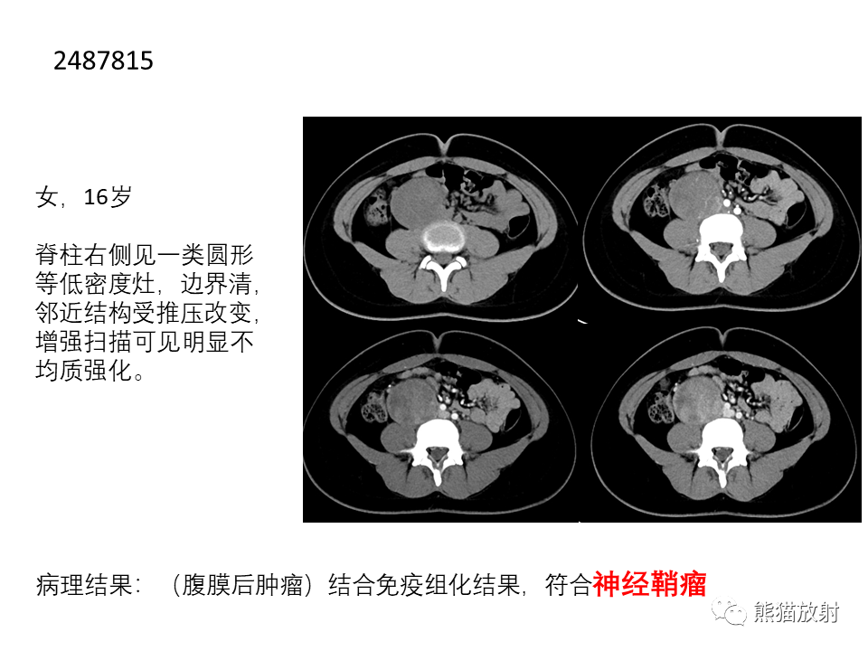 影像PPT - 【病例】腹膜后副神经节瘤 VS 平滑肌肉瘤-35
