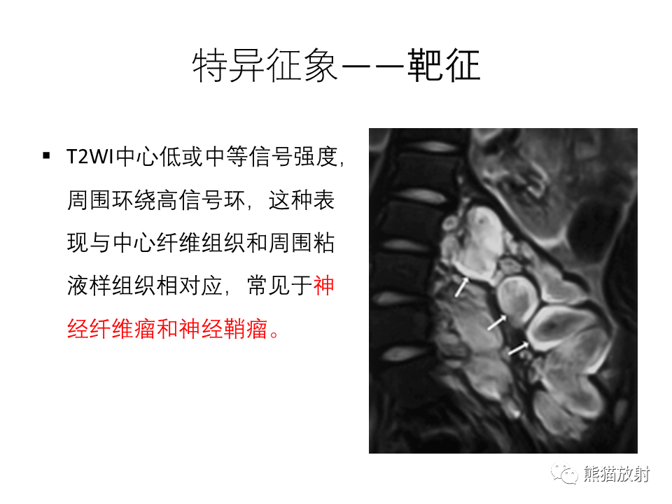 影像PPT - 【病例】腹膜后副神经节瘤 VS 平滑肌肉瘤-36