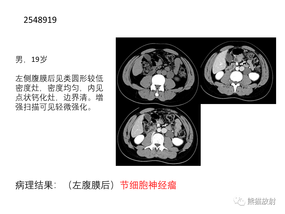 影像PPT - 【病例】腹膜后副神经节瘤 VS 平滑肌肉瘤-38