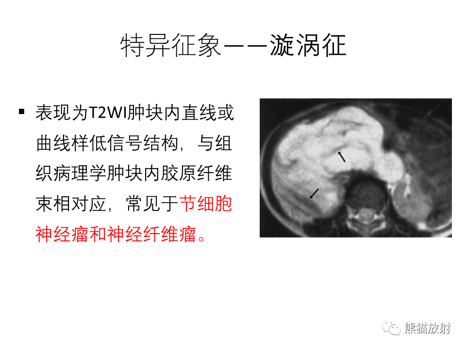 影像PPT - 【病例】腹膜后副神经节瘤 VS 平滑肌肉瘤-39