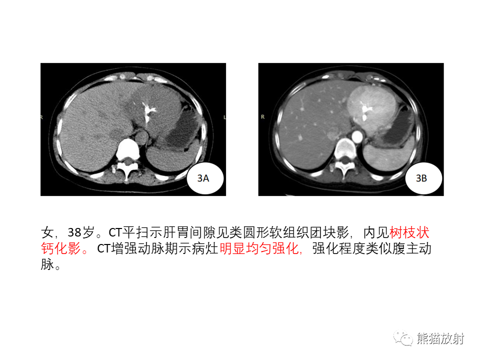 影像PPT - 【病例】腹膜后副神经节瘤 VS 平滑肌肉瘤-41