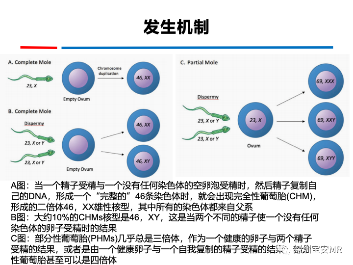 影像PPT - 【PPT】妊娠滋养细胞疾病-14