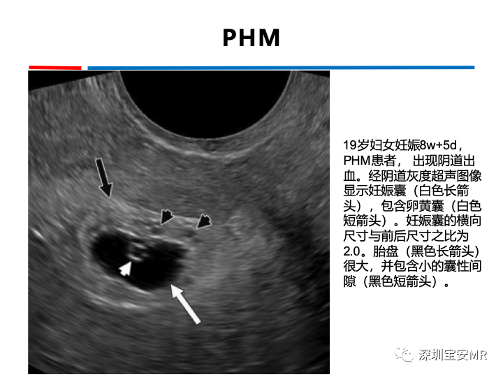 影像PPT - 【PPT】妊娠滋养细胞疾病-22