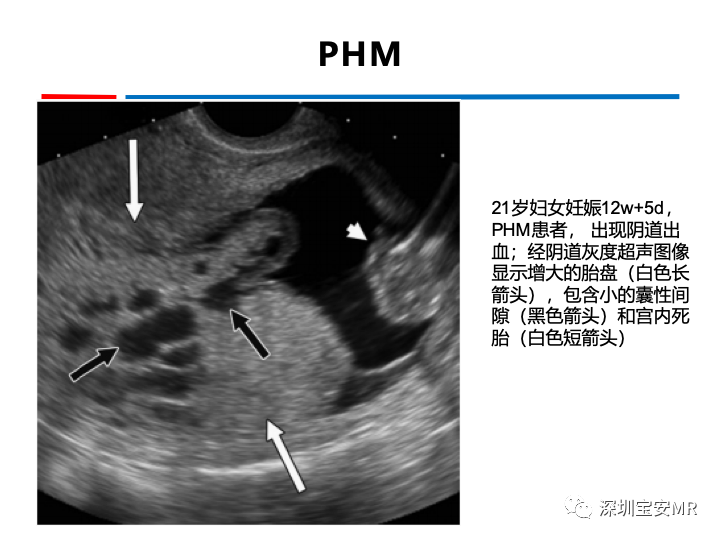 影像PPT - 【PPT】妊娠滋养细胞疾病-23