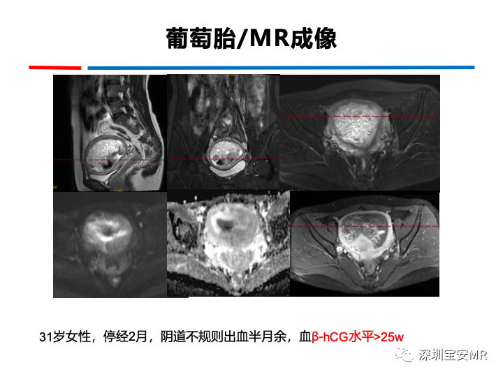 影像PPT - 【PPT】妊娠滋养细胞疾病-26
