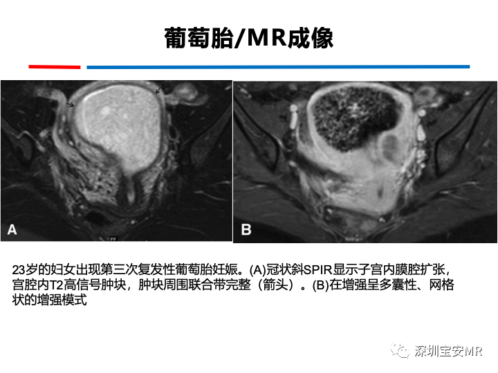 影像PPT - 【PPT】妊娠滋养细胞疾病-27