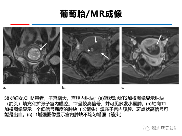 影像PPT - 【PPT】妊娠滋养细胞疾病-28