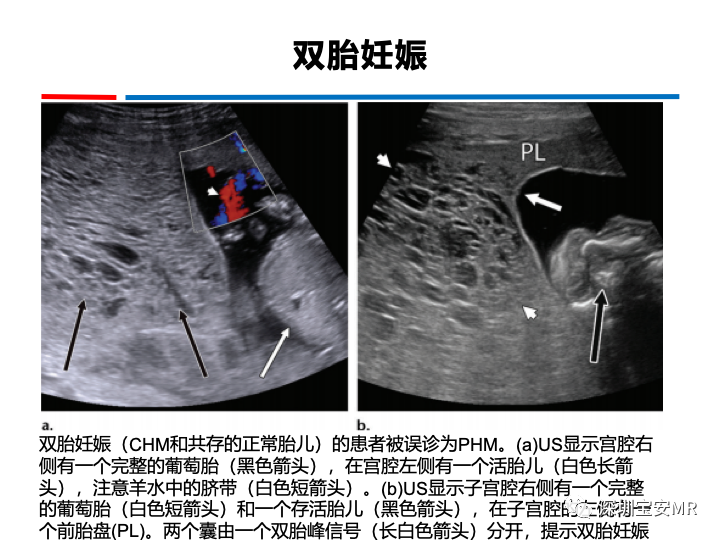 影像PPT - 【PPT】妊娠滋养细胞疾病-30