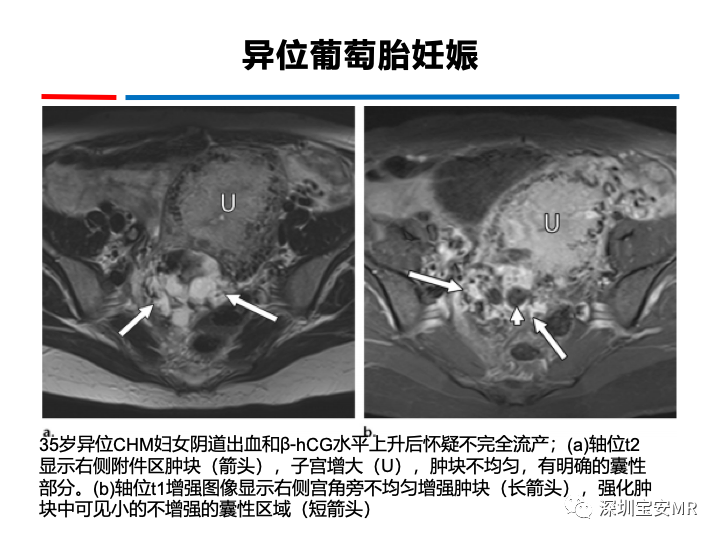 影像PPT - 【PPT】妊娠滋养细胞疾病-32