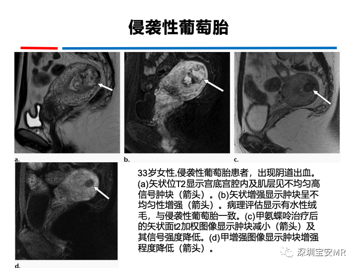影像PPT - 【PPT】妊娠滋养细胞疾病-44