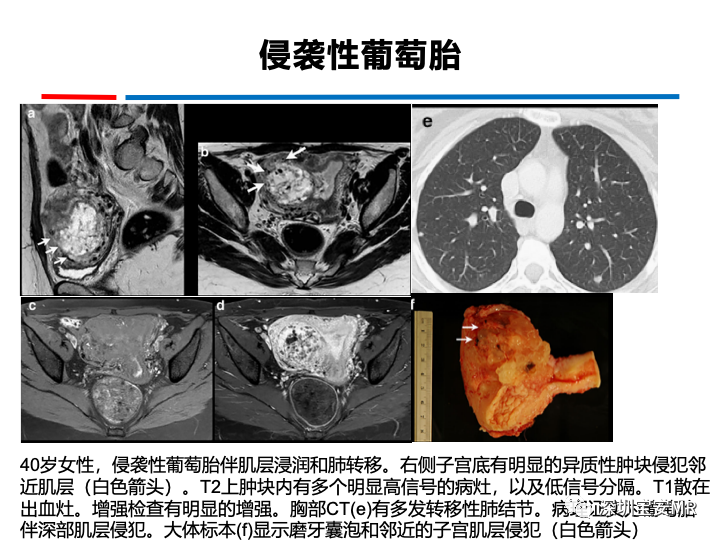 影像PPT - 【PPT】妊娠滋养细胞疾病-45