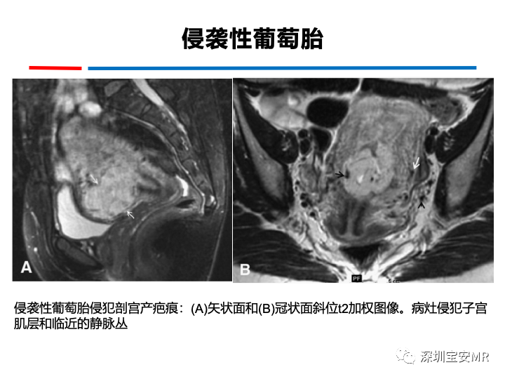 影像PPT - 【PPT】妊娠滋养细胞疾病-46