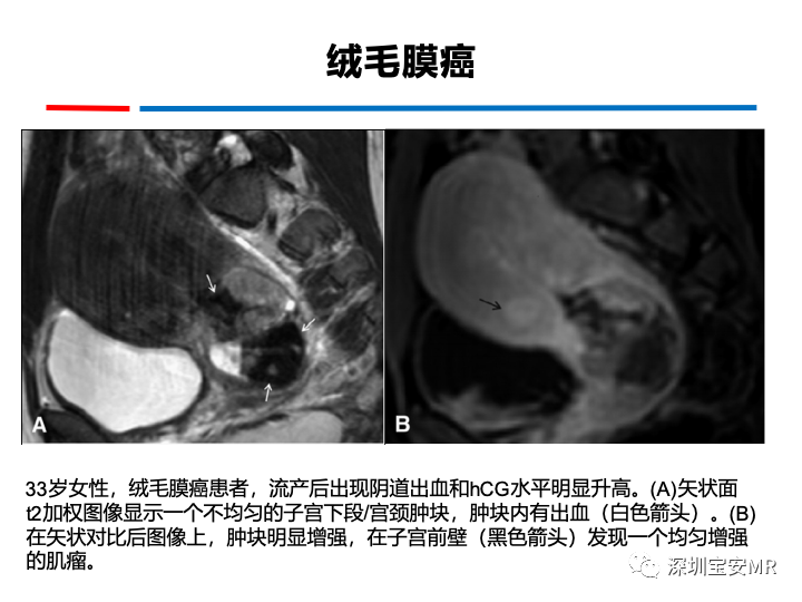 影像PPT - 【PPT】妊娠滋养细胞疾病-47