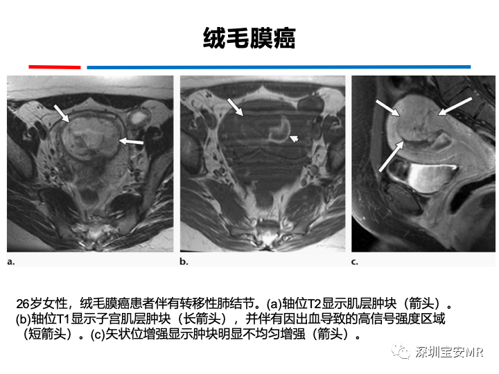 影像PPT - 【PPT】妊娠滋养细胞疾病-48