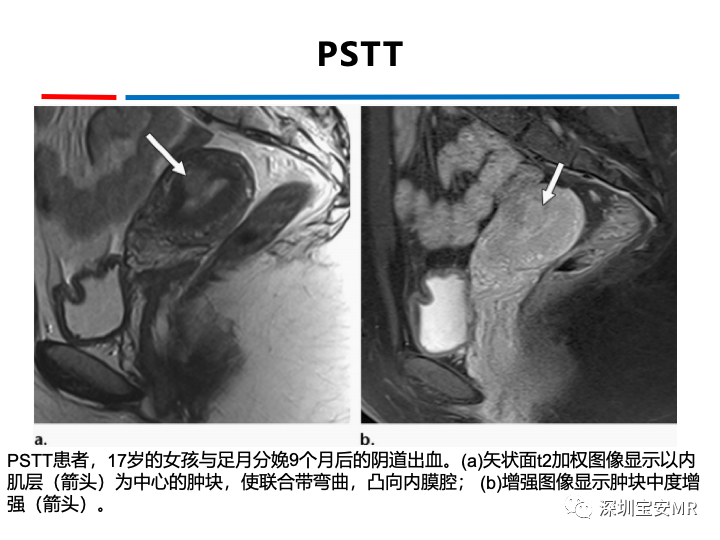 影像PPT - 【PPT】妊娠滋养细胞疾病-50