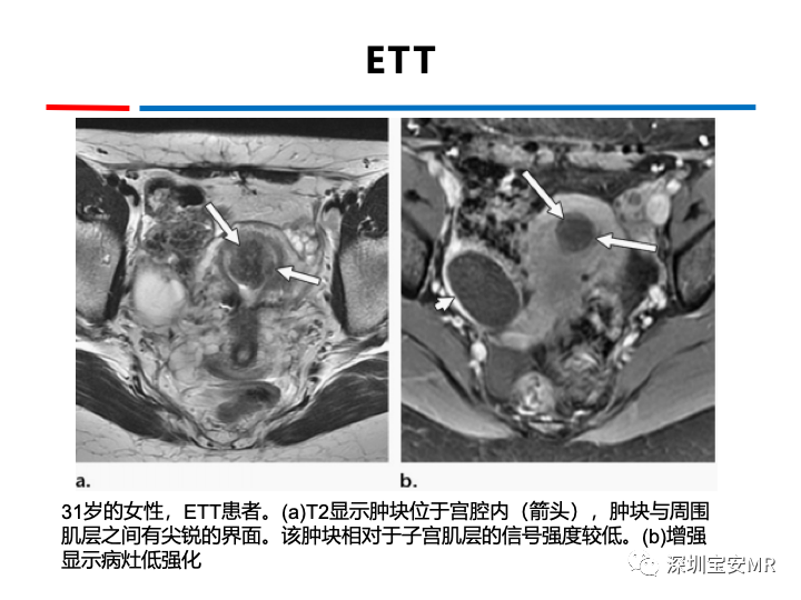 影像PPT - 【PPT】妊娠滋养细胞疾病-51