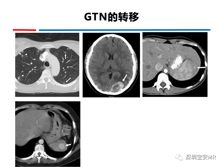 影像PPT - 【PPT】妊娠滋养细胞疾病-53