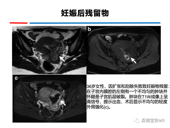 影像PPT - 【PPT】妊娠滋养细胞疾病-58