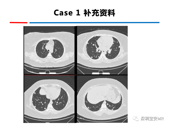 影像PPT - 【PPT】妊娠滋养细胞疾病-61