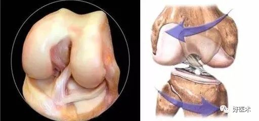 影像PPT - 56张高清图,牢记半月板的解剖-14 影像PPT - 56张高清图,牢记半月板的解剖-14