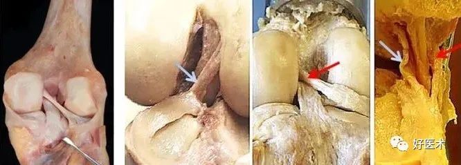 影像PPT - 56张高清图,牢记半月板的解剖-33 影像PPT - 56张高清图,牢记半月板的解剖-33