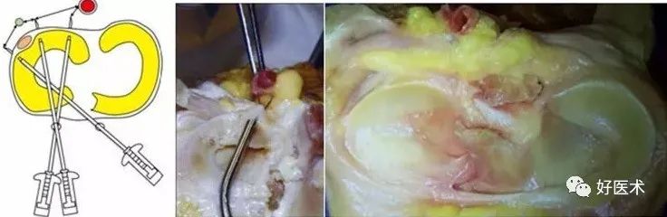 影像PPT - 56张高清图,牢记半月板的解剖-50 影像PPT - 56张高清图,牢记半月板的解剖-50
