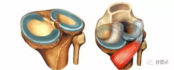 影像PPT - 56张高清图,牢记半月板的解剖-56 影像PPT - 56张高清图,牢记半月板的解剖-56