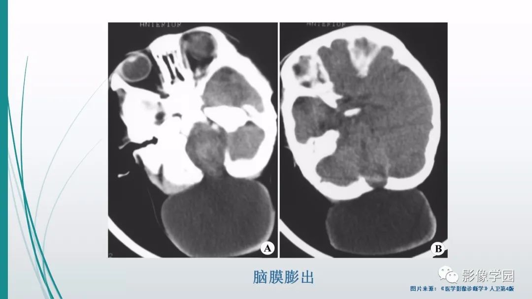 影像PPT - 【PPT】颅脑先天性畸形及发育异常的影像诊断-6