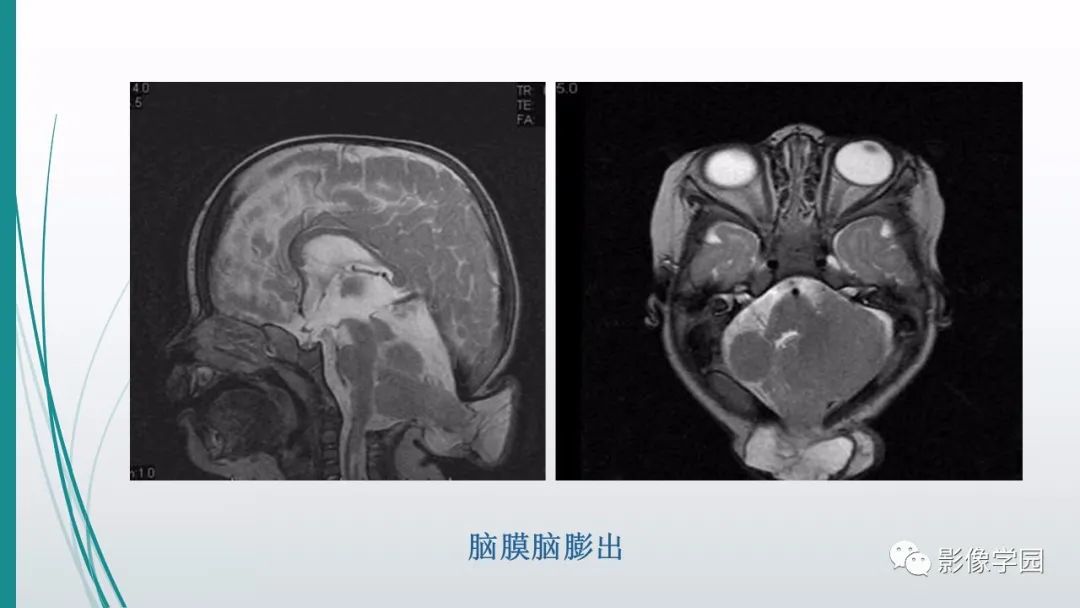 影像PPT - 【PPT】颅脑先天性畸形及发育异常的影像诊断-7