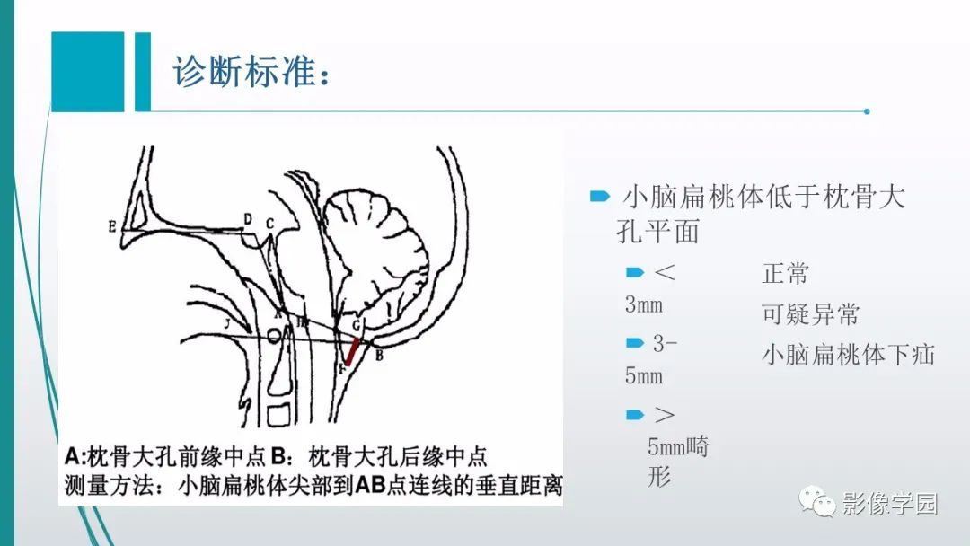 影像PPT - 【PPT】颅脑先天性畸形及发育异常的影像诊断-9