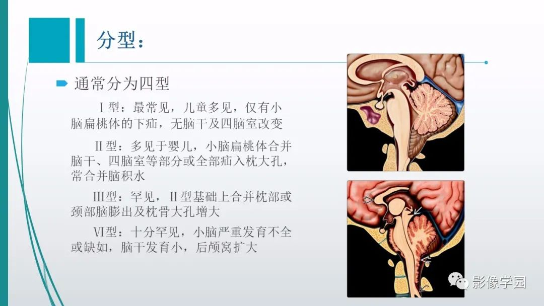 影像PPT - 【PPT】颅脑先天性畸形及发育异常的影像诊断-10