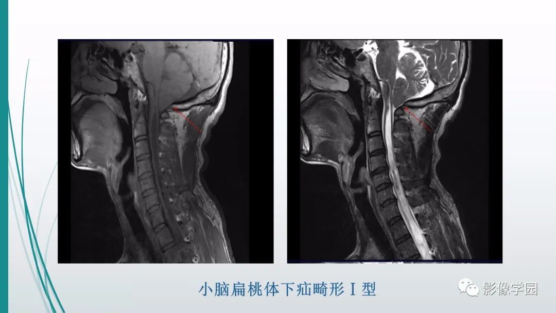 影像PPT - 【PPT】颅脑先天性畸形及发育异常的影像诊断-12