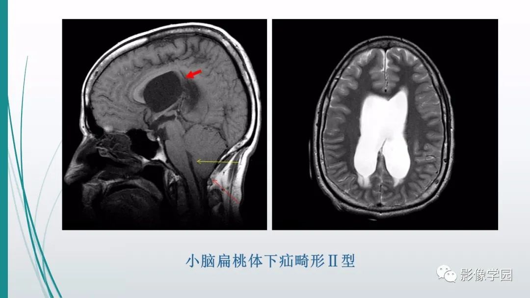 影像PPT - 【PPT】颅脑先天性畸形及发育异常的影像诊断-13