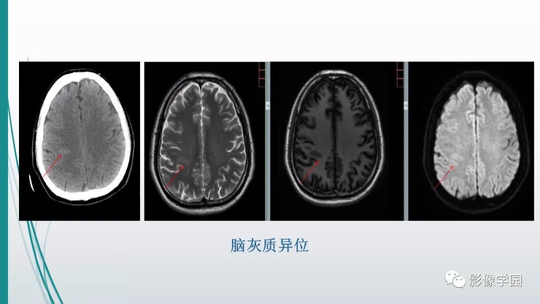 影像PPT - 【PPT】颅脑先天性畸形及发育异常的影像诊断-19