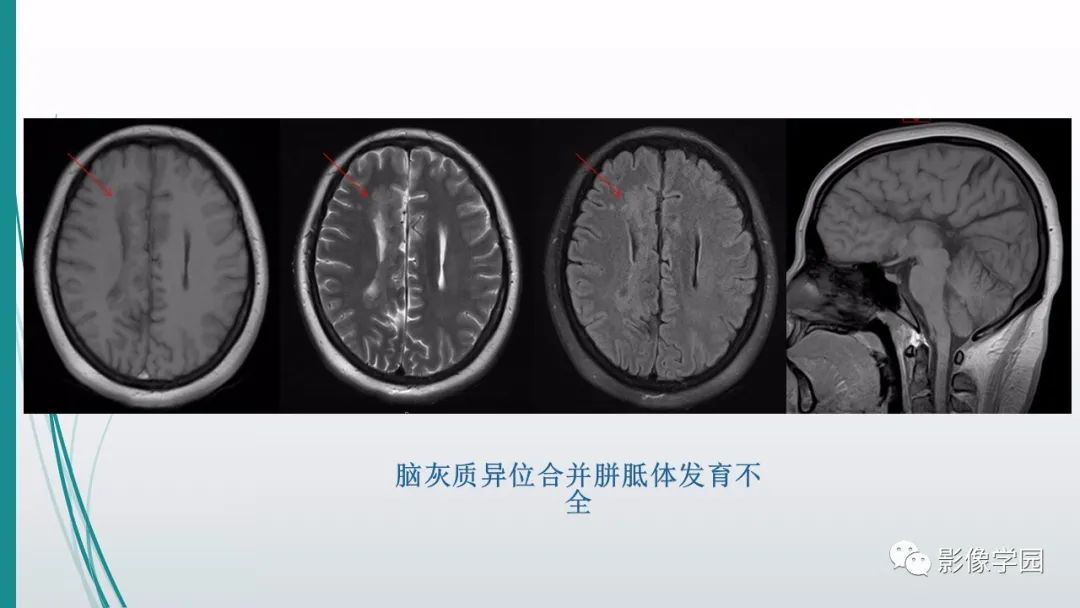 影像PPT - 【PPT】颅脑先天性畸形及发育异常的影像诊断-20